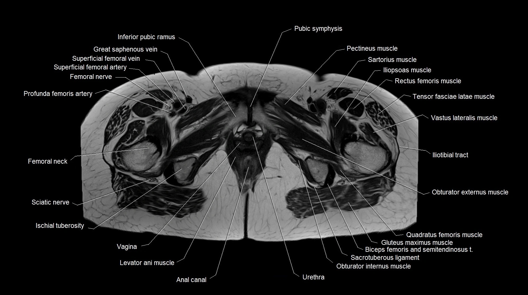 MRI 3T pelvis axial cross section anatomy image 29.webp